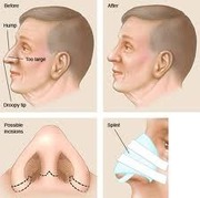  best Nose Reshaping in hyhderabad